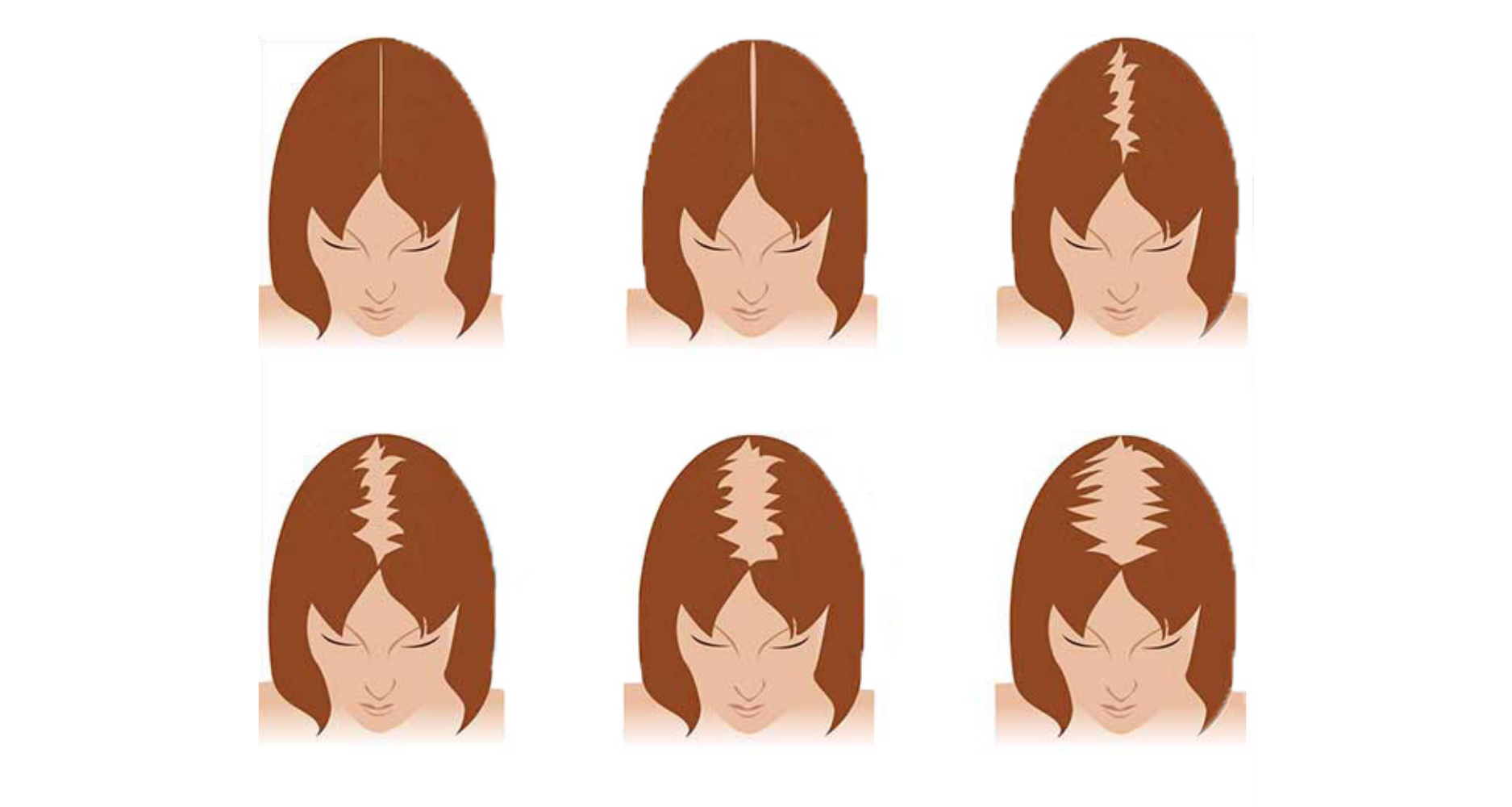 סוגי נשירת שיער בקרב נשים: המדריך המקיף להבנת התופעה 👩🦰